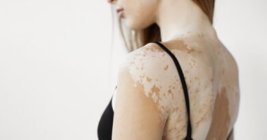 Vitiligo Nedir? Nedenleri ve Tedavi Seçenekleri Nelerdir?