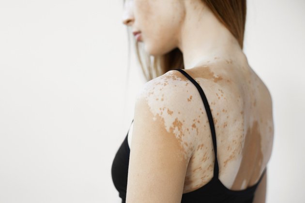 Vitiligo Nedir? Nedenleri ve Tedavi Seçenekleri Nelerdir?