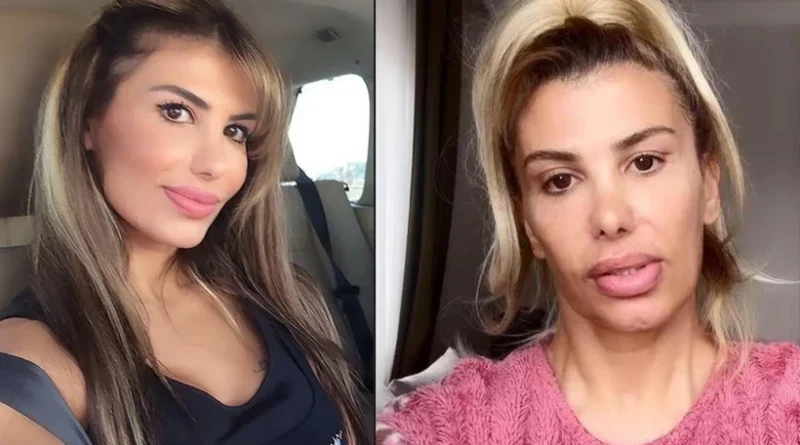 Botoks Macerası Kabusa Dönüştü!