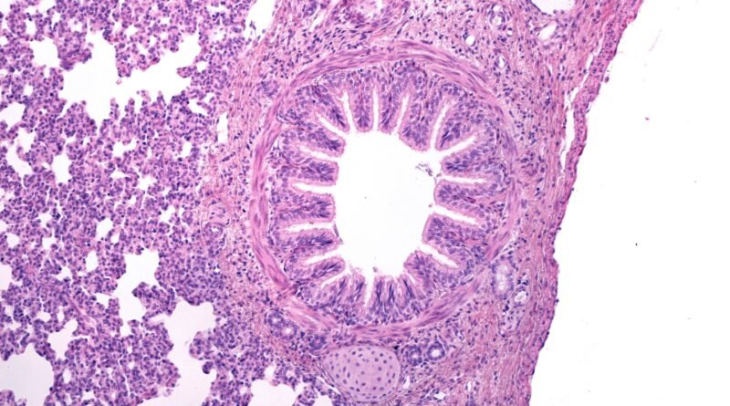 Kordoma: Nedir, Belirtileri ve Tedavi Yöntemleri