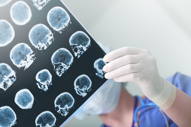 Epilepsi (Sara) Nedir? Belirtileri ve Tedavi Yöntemleri