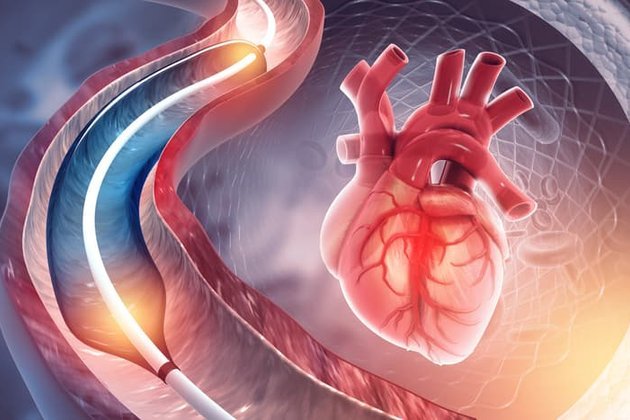 Anjiyo Nedir ve Nasıl Uygulanır?