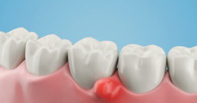 Diş Kisti Nedir? Belirtileri ve Nasıl Tedavi Edilir?