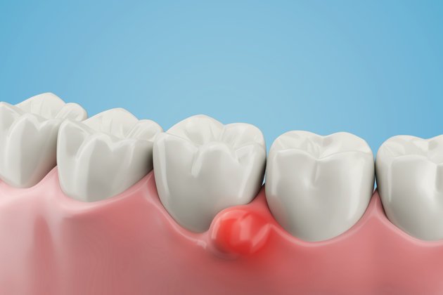 Diş Kisti Nedir? Belirtileri ve Nasıl Tedavi Edilir?