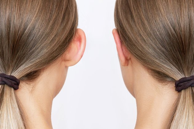 Kepçe Kulak Ameliyatı (Otoplasti) Nedir? Belirtileri ve Tedavi Yöntemleri