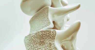 Osteoporoz (Kemik Erimesi) Nedir ve Belirtileri Nelerdir?