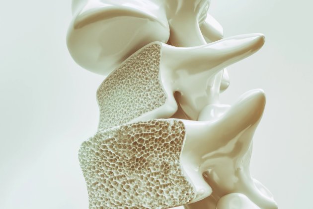 Osteoporoz (Kemik Erimesi) Nedir ve Belirtileri Nelerdir?