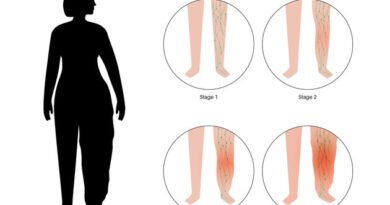 Lipödem Nedir? Belirtileri ve Tedavi Yöntemleri Nelerdir?