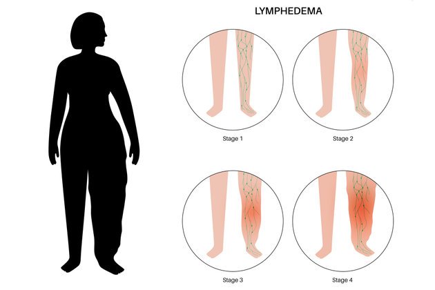 Lipödem Nedir? Belirtileri ve Tedavi Yöntemleri Nelerdir?