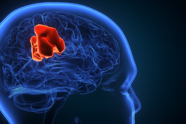 Glioblastom (GBM) Nedir ve Belirtileri Nelerdir?