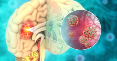 Beyin Tümörü Nedir? | Anadolu Sağlık Merkezi