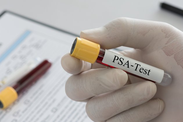 PSA Nedir? PSA Testi Değerleri Ne Olmalı?