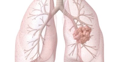 Akciğerde Skuamöz Hücreli Karsinom Nedir?  →  Akciğerdeki Skuamöz Hücreli Karsinom Nedir?
