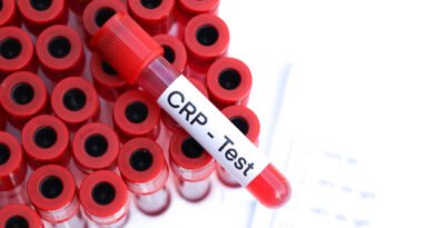 CRP Nedir? CRP Yüksekliği Hakkında Bilgiler | Anadolu Sağlık Merkezi