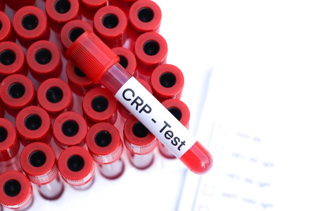 CRP Nedir? CRP Yüksekliği Hakkında Bilgiler | Anadolu Sağlık Merkezi