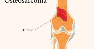Osteosarkom Nedir? Belirtileri ve Tedavi Yöntemleri