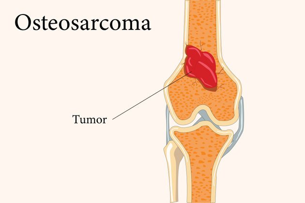Osteosarkom Nedir? Belirtileri ve Tedavi Yöntemleri