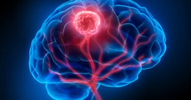 Anevrizma Nedir? Beyin Anevrizmasının Belirtileri Nelerdir?