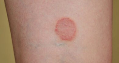 Liken Planus Nedir ve Belirtileri Nelerdir?