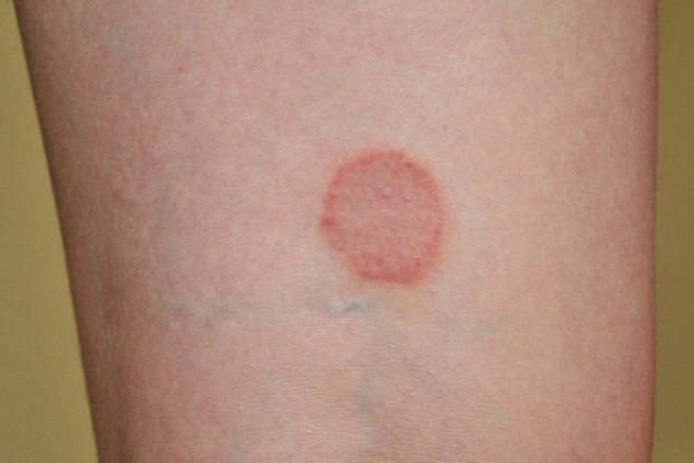 Liken Planus Nedir ve Belirtileri Nelerdir?