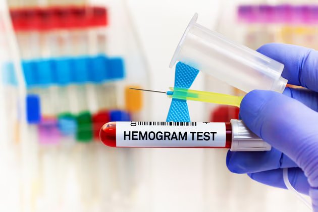 MCV Nedir? MCV Düşüklüğü ve Yüksekliği Hakkında Bilgi