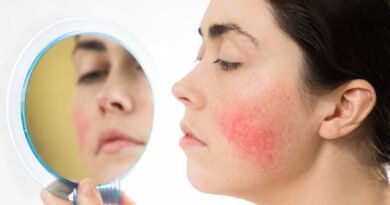 Gül Hastalığı Nedir ve Neden Oluşur?