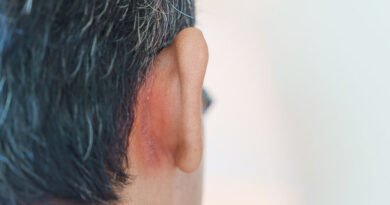 Seboreik Dermatit Nedir ve Belirtileri Nelerdir?