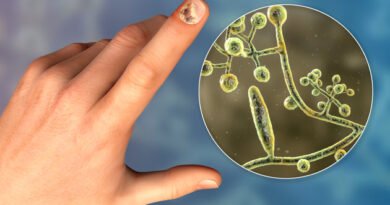 Tırnak Mantarı Nedir? Nedenleri, Belirtileri ve Tedavi Yöntemleri nelerdir?