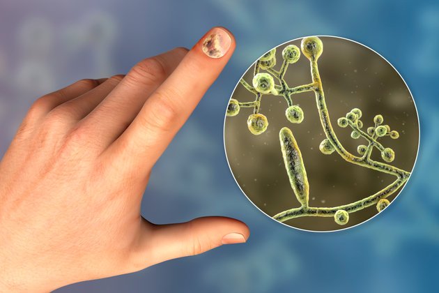 Tırnak Mantarı Nedir? Nedenleri, Belirtileri ve Tedavi Yöntemleri nelerdir?