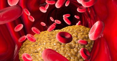 Venöz Yetmezlik Nedir ve Nasıl Tedavi Edilir?