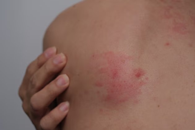 Candida Mantarı Nedir? Belirtileri, Nedenleri ve Tedavi Yöntemleri