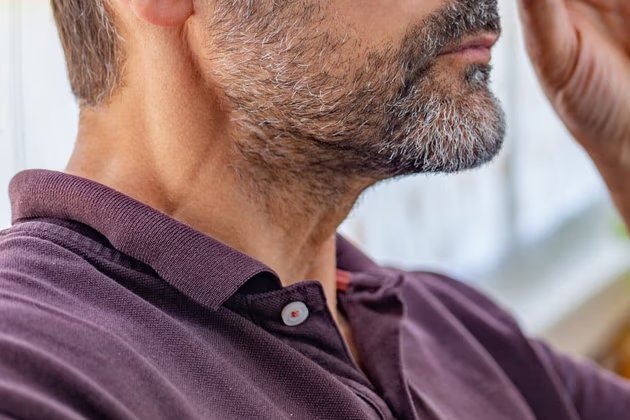 Sakal Kıran Nedir? Nedenleri, Belirtileri ve Tedavi Yöntemleri Nelerdir?