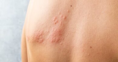 Yılancık Hastalığı (Erizipel): Nedir, Belirtileri ve Tedavi Yöntemleri