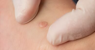 Eritema Multiforme Nedir? Nedenleri, Belirtileri ve Tedavi Yöntemleri Nelerdir?