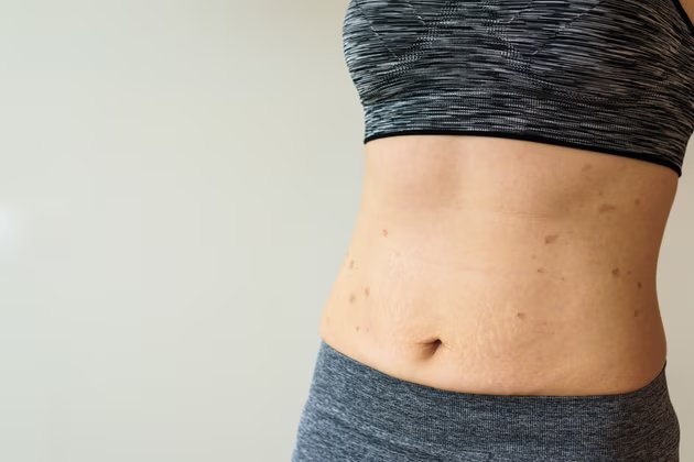 Göbek Düşmesi: Nedir, Nedenleri, Belirtileri ve Tedavi Yöntemleri