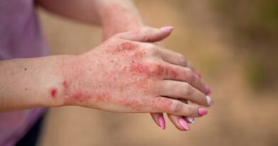 Tinea Corporis Nedir? Nedenleri, Belirtileri ve Tedavi Yöntemleri Nelerdir?